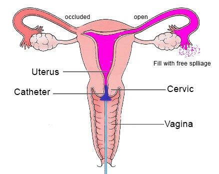 Test HSG (Hysterosalpingography) – It’s Hurt! :(